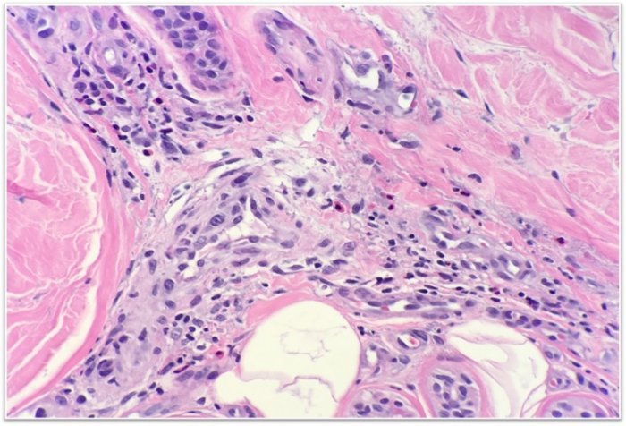 Diffuse Rash Pathology A diffuse and morphologically diverse rash in a traveler - Dermatology ...